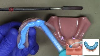 Laboratory Reline for LOCATOR and LOCATOR RTx Dentures StepByStep Technique [upl. by Saticilef642]