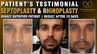 Correction Deviated Septum Septoplasty  Rhinoplasty Nose Before amp After Result  Happy Patient [upl. by Hanonew]