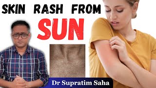 धूप से एलर्जी  PMLE  Most common skin rash from sun exposure  Hindi  Dr Supratim Saha [upl. by Maisie]