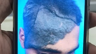 Srijan Plastic Surgery is live  follow up result of giant hairy nevus [upl. by Akimat]