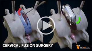 Anterior Cervical Fusion [upl. by Mochun]