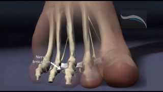 Best Custom Orthotics for Mortons NeuromaMichael Berry DCChiropractor in Tustin [upl. by Aloz]