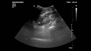 pleural fibrous tumor [upl. by Ttirrem911]