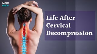 Life After Cervical Decompression [upl. by Nomelif]