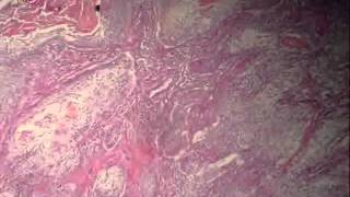 Bronchogenic carcinoma عملي عبد الرحمن خليفة [upl. by Christina]