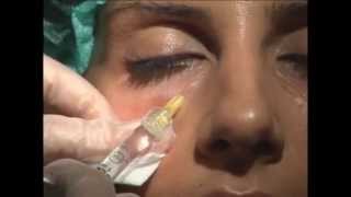 Relleno de Ojeras  Tratamiento Facial [upl. by Arlyn153]