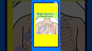 Needle aspiration in Pneumothorax pneumothorax medicine respiratorydisease respiratorycare [upl. by Winnifred532]