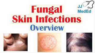 Overview of Fungal Skin Infections  Tinea Infections [upl. by Rafaelita]