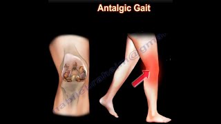 Painful Gait Antalgic Gait painful gait [upl. by Yorgerg916]