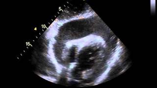 Echocardiography with a Significant Pericardial Effusion [upl. by Arjun]