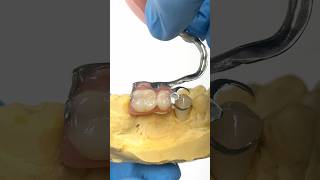 Adding a Crown for a Metal Clasped Partial lsk121shorts dentistry teeth [upl. by Kimble904]