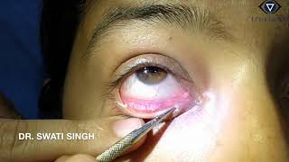 Lacrimal Syringing Technique and Interpretation [upl. by Pepita180]