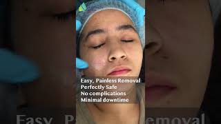 Mole wart removal with painless RF laser [upl. by Letnohc]