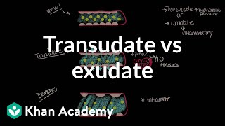 Pleural effusionTransudate vs exudate Light criteria [upl. by Croom]