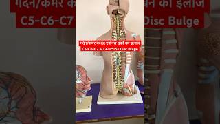 Cervical Problem amp Lower Back Pain Treatment shorts sciatica neckpain [upl. by Venezia]