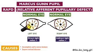 Abnormal Pupillary Reflexes  Ophthalmology [upl. by Imorej]