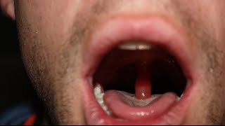 swollen throat clinical case answer and discussion [upl. by Eudoca484]