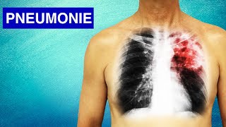 Pneumonie  Symptômes Diagnostic et Traitements [upl. by Katlaps119]