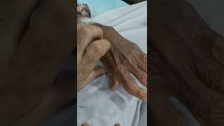 Osteoarthritis of fingers  Heberdens Nodes [upl. by Dawna]