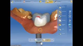 Coroane dentare si bont protetic realizate digital intro singura sedinta cu Cerec CadCam [upl. by Omora60]