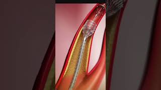 एंजियोप्लास्टी में स्टेंट कैसे लगाते है Angioplasty Stent Insertion Tutorial  StepbyStep Guide [upl. by Htidirem]