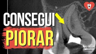 4 PASSOS PARA CORRIGIR ESSE ERRO NESSE CANAL CALCIFICADO  Endolovers [upl. by Akemet]