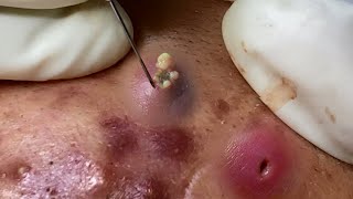 Big Cystic Acne Blackheads Extraction Blackheads amp Milia Whiteheads Removal Pimple Popping 053 [upl. by Idnic]