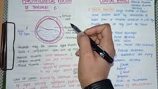 Thrombosis Part 2  Definition Causes Types Morphology amp Pathology [upl. by Noe]