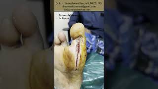 Great Toe Trophic Ulcer infection salvage [upl. by Anayhd703]