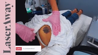 Laser Tattoo Removal Experience in London Part 1 [upl. by Rodrich]