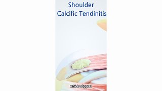 Unveiling The Stages Of Calcific Tendinitis Symptoms [upl. by Boice]