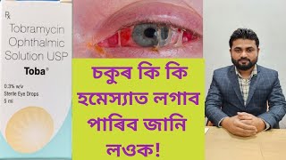 Toba Eye Drops Tobramycin Ophthalmic Solution USP [upl. by Hbahsur]