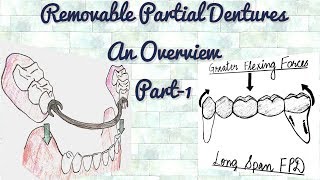 Removable Partial DenturesAn Overview Part1Indications of RPD [upl. by Ferd]