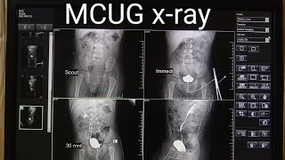 MCUGVCUG xRay procedure micturating cystourethrogram  MCUGVCUG test in Radiology [upl. by Rysler]