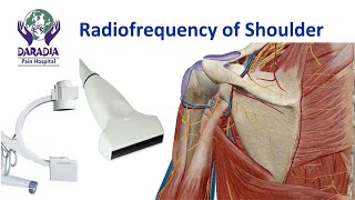 Shoulder Joint Radiofrequency Procedure  Cooled RF of shulder [upl. by Alleira]