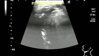 Ultrasound Video showing a small and illdefined mass in Parotid gland A rare case [upl. by Mmada8]