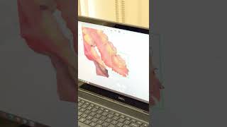 Intraoral scanning with 3 shape scanner [upl. by Abih]