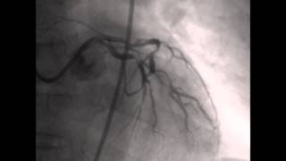 Coronary angiography CAG [upl. by Bust]