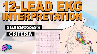 Sgarbossas Criteria  HOW TO Identify AMI with LBBB on 12lead EKG [upl. by Odelle]