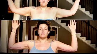 Brachioplasty Arm Lift before and after  3day 3wk amp 8wk recovery progress  PCOS weightloss [upl. by Enimsaj]