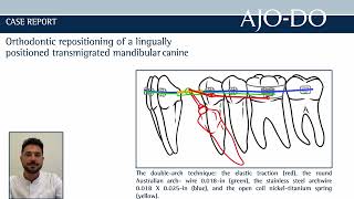 Orthodontic repositioning of a lingually positioned transmigrated mandibular canine [upl. by Brebner]