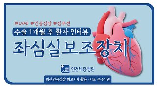 심부전 환자 인공심장수술LVAD 후기 l 인천세종병원 심장이식센터 [upl. by Ahseiuqal]