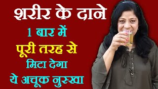 घमौरियों के घरेलू नुस्खे  ghamoriyo ka ilaj  How To Cure Heat Rashes  gamori ka ilaj [upl. by Platon]