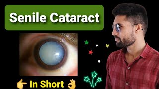 Senile cataract lecture opthalmology [upl. by Mccafferty]