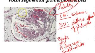 USMLE Review  Renal Nephrotic syndromes [upl. by Enelhtac]