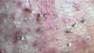 How To Remove Blackheads And Whiteheads On Face Easy 78 ✦ Dr Laelia ✦ [upl. by Arjan]