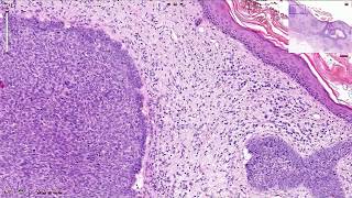 Basal Cell Carcinoma Including Variants  Histopathology [upl. by Dalury]