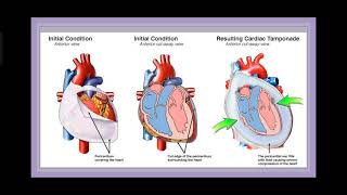 Cardiac Arrest Pulseless Electrical Activity [upl. by Ettinger391]