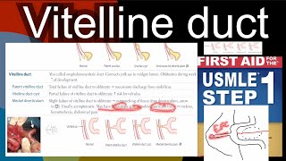 Vitelline duct  Patent vitelline duct Vitelline duct cyst Mackel diverticulum in HindiUrdu [upl. by Atikihs]