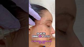 Filler under the hairline filler temples renuva medspa aesthetics before andafter [upl. by Ynetsed]